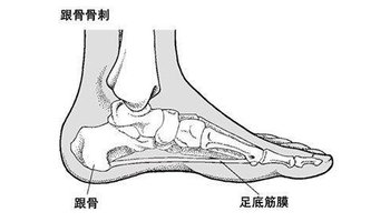 足跟骨刺即足跟骨质增生,其症状是足跟压痛, 走路时脚跟不敢用力,有石