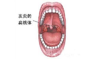 921980041_舌根部_舌根部淋巴滤泡增生