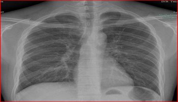 常见肺部感染胸片-在线图片欣赏