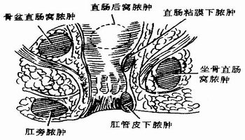 直肠肛管周围脓肿