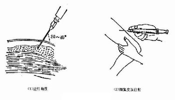 常用注射部位为上臂及股外侧.