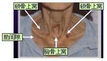 三凹征(three depression sign)是指吸气时胸骨上窝,锁骨上窝,肋间隙