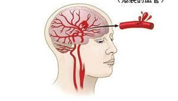 脑溢血严重吗 引起的中风能治好