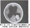 儿童脉络丛乳头状瘤