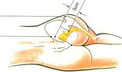 经筋手法加针灸治疗梨状肌综合征37例