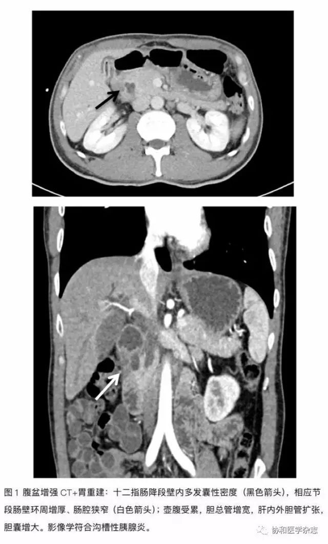 协和病例:上消化道梗阻、黄疸、胰腺病变，是……