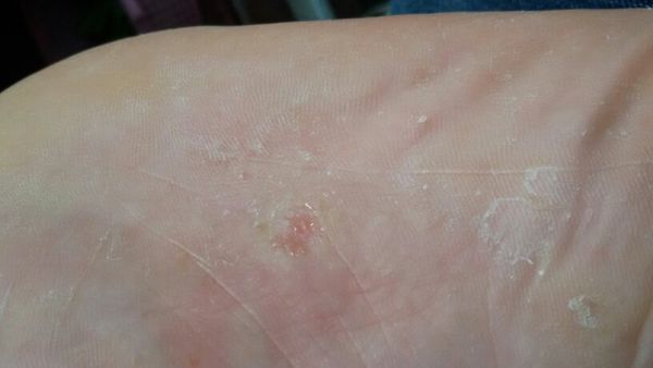 我的脚好痒看上去皮下鼓了许多小水泡,用手一