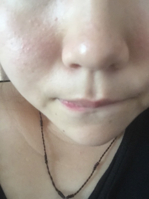 闭合性粉刺怎么治?_360问答