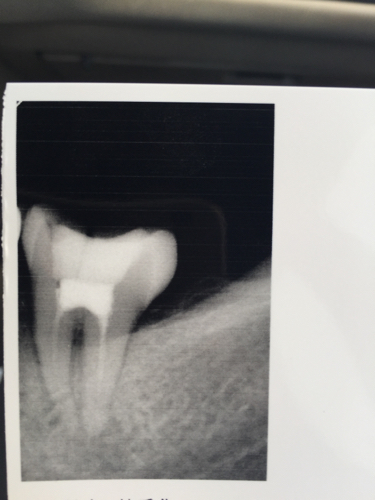 我左边下面最后一颗牙做过根管治疗,但是昨天
