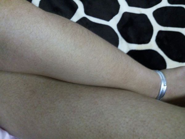 我的腿上从小就有这种小粒小粒的东西,呈红紫