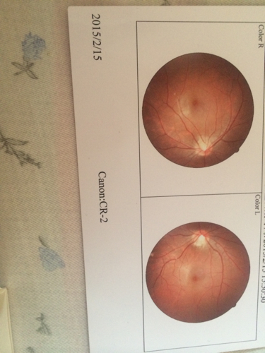 女,最近到医院检查眼睛,查了眼压正常,也检查了
