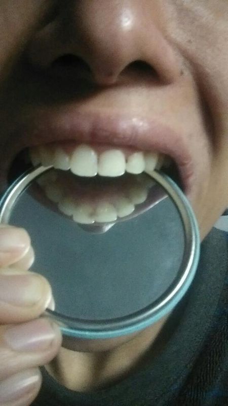 门牙后面发黑,确定是蛀牙了,不补牙行吗?能控