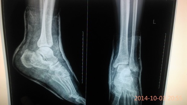 脚跟骨骨折,脚踝错位,一个月前和一个月后的片