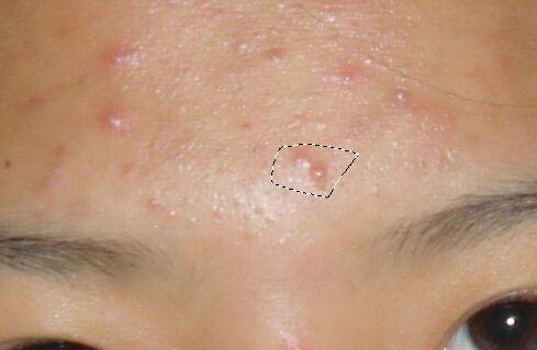 photoshop 照片如何去除脸上痘印_360问答