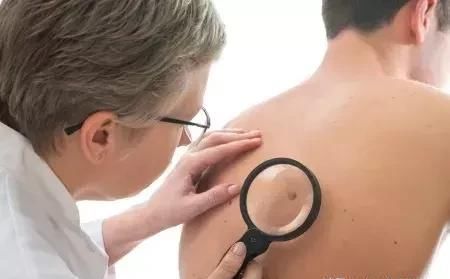 背上、胸口爱长痘痘是怎么回事?