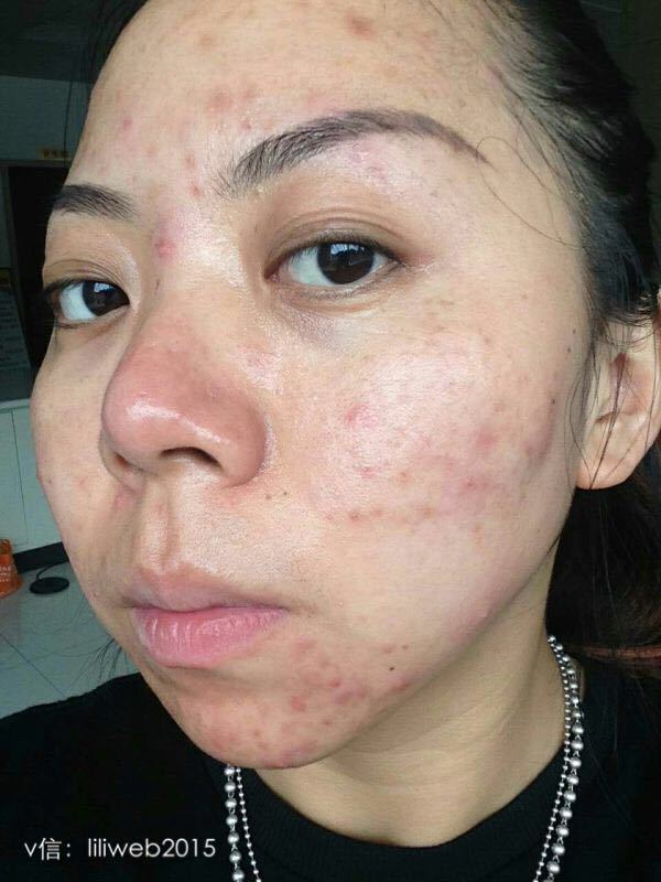 面膜说不能用于皮肤炎症或湿疹之处?那有痘痘能用吗??仙人掌锁水面膜。_360问答