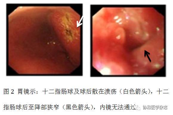 协和病例:上消化道梗阻、黄疸、胰腺病变，是……