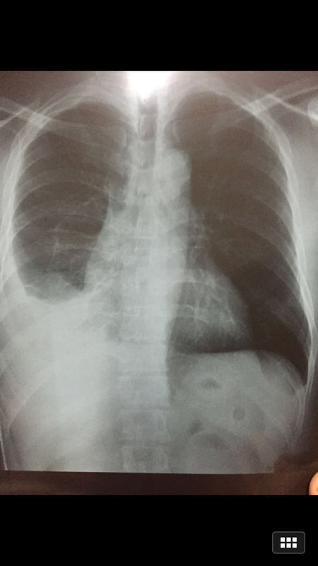 北京特色医院,结核性胸膜炎应该去哪个医院最