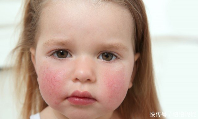小孩皮肤过敏怎么办 要如何处理