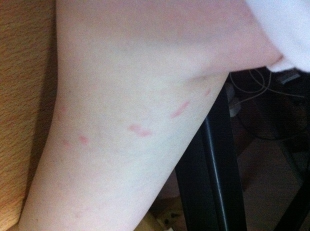 身上起了小红疙瘩很痒,挠挠就变大了,直到挠破