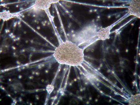 多发性骨髓瘤肾病