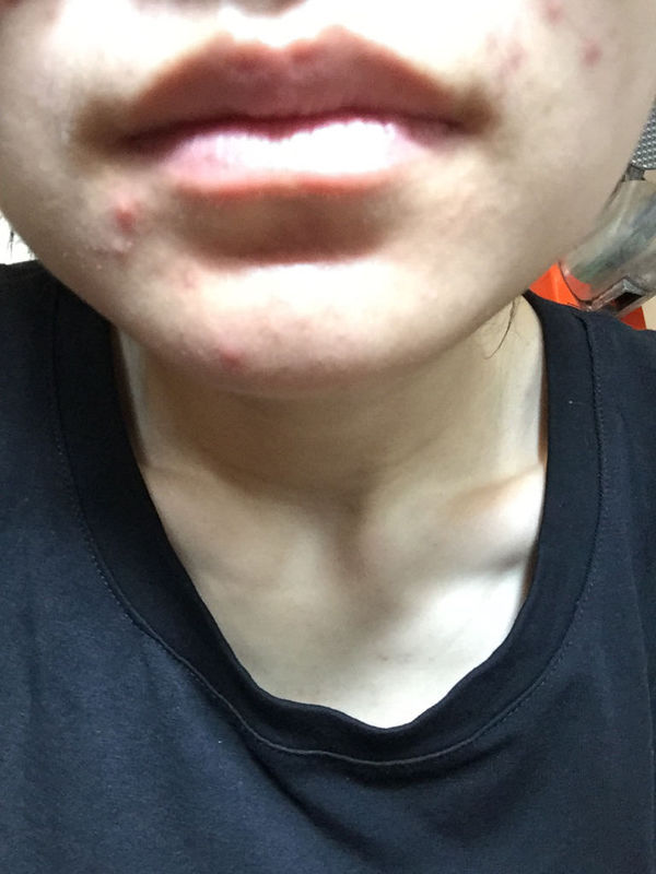 头发洗了像没洗,嘴唇周围长痘痘,大便一直不成