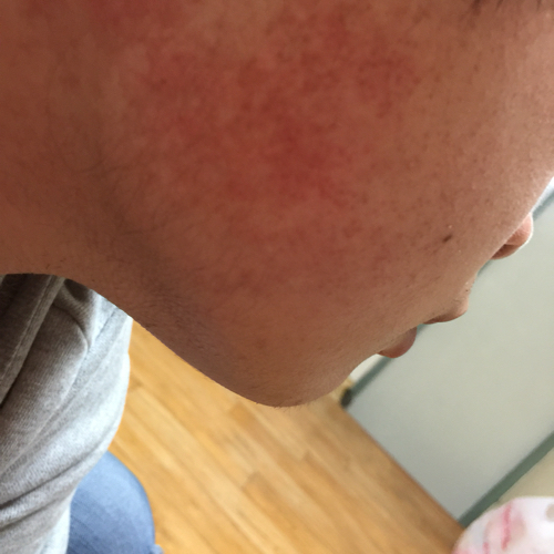 脸颊两边有都有一片红色的小麻点,不痛不痒,好