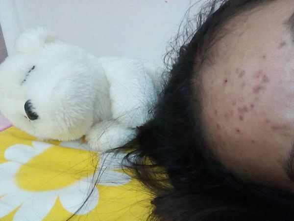 痘痘痘印 我该怎么办 去医院要了阿达帕林凝胶