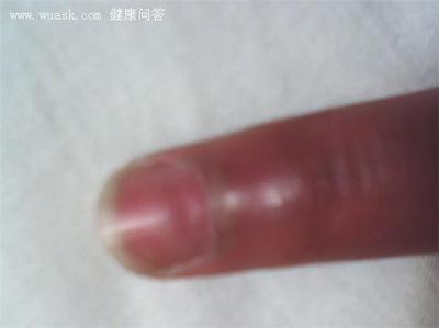 脚大拇指指甲凹陷-脚大拇指指甲凹陷最新资讯