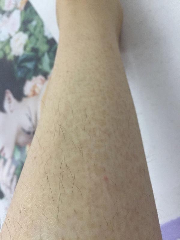 小腿上出现一块块的褐色斑块 没有任何感觉_3