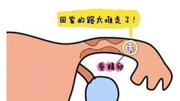 宫外孕的发病原因是什么?典型病症又是什么?