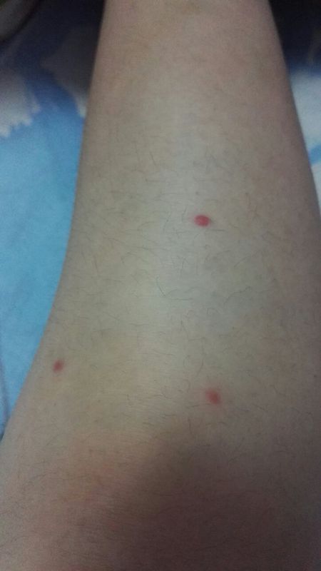 这是什么虫子咬的?不痛不痒就是很红 每到夏初