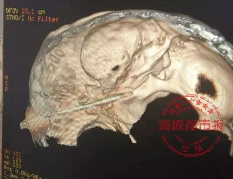 福州男子头插水果刀,淡定排队就诊。所幸没有