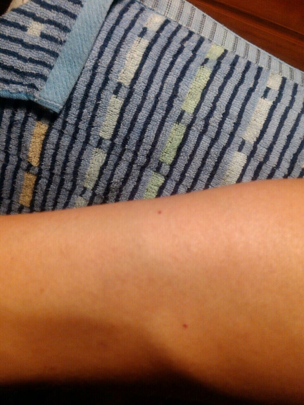 我的手臂上长了两个突出的红点,别人说可能是血液病,不知道是吗?