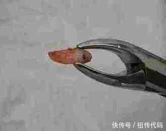 男子鼻子里长了20年的异物, 近来时痛时痒, 医生拔出后却看