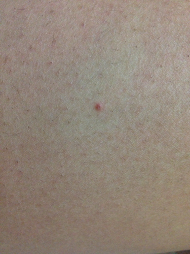 腿上的。跟粉刺差错多 有的是小红点 有的是个