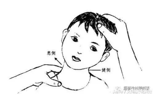 到现在为止,你么你还以为痉挛性斜颈是不治之