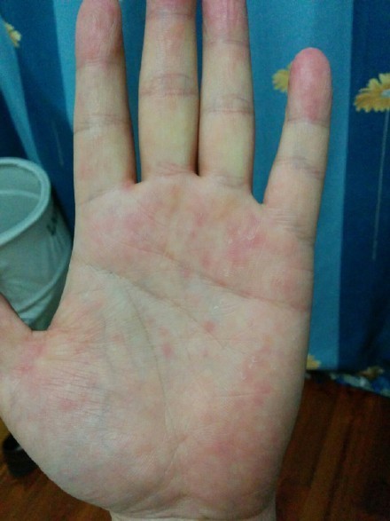 手掌皮下反复出小红点_360问答