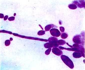 白色念珠菌(monilia albican 或 canidia albicans),是一种真菌