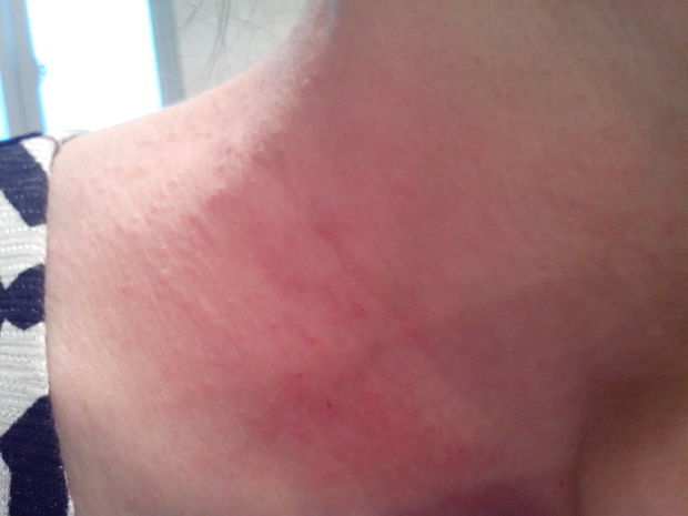 有没有治疗神经性皮炎的妙招?