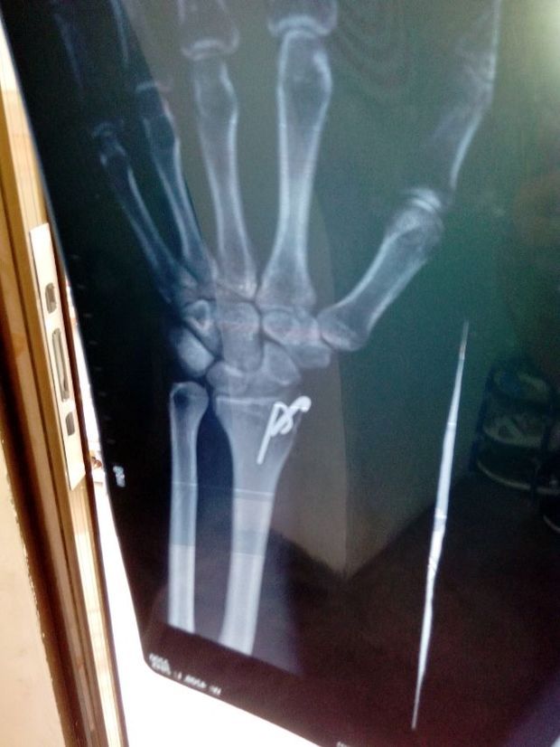 右手桡骨骨折内固定 右尺骨远端骨折 能评几级