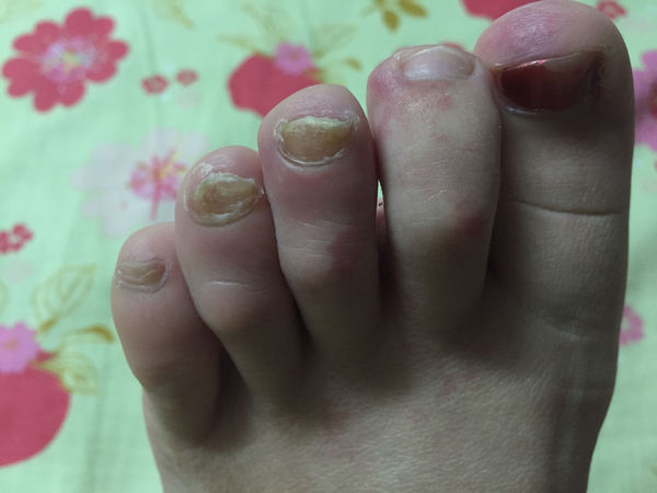 问:我的脚指甲本来一个变成灰色,后来整只脚都