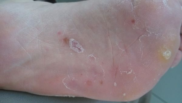 鳞屑角化型足癣图片谢谢?_360问答