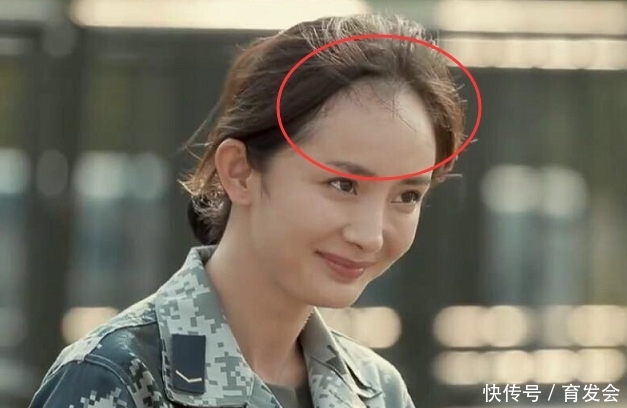 为何明星比普通人更容易脱发?专家揭示脱发根