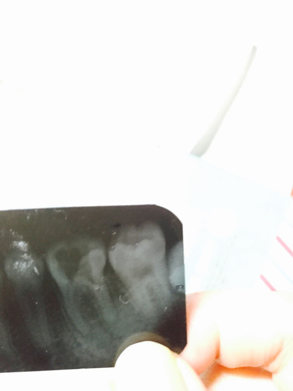 今天去华西做根管治疗拍牙片,发现左边最后一