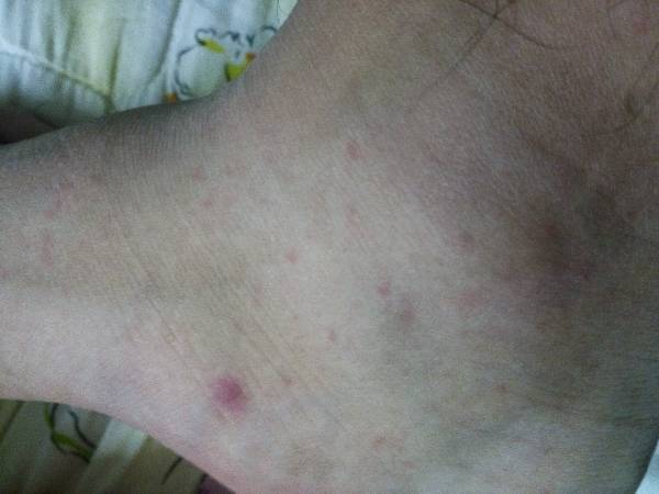 ,这些小红点点是过敏吗?一身都是舌头上也有,