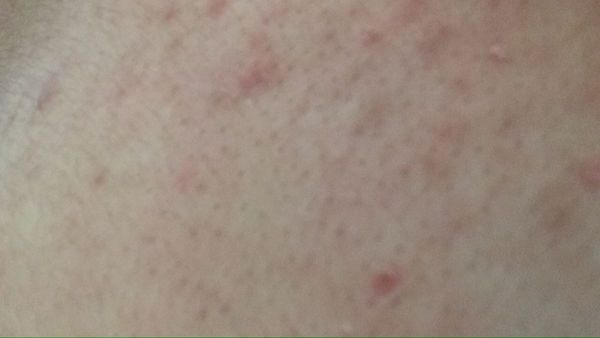 胸部背部长这种痘痘还是什么东西怎么办啊、_