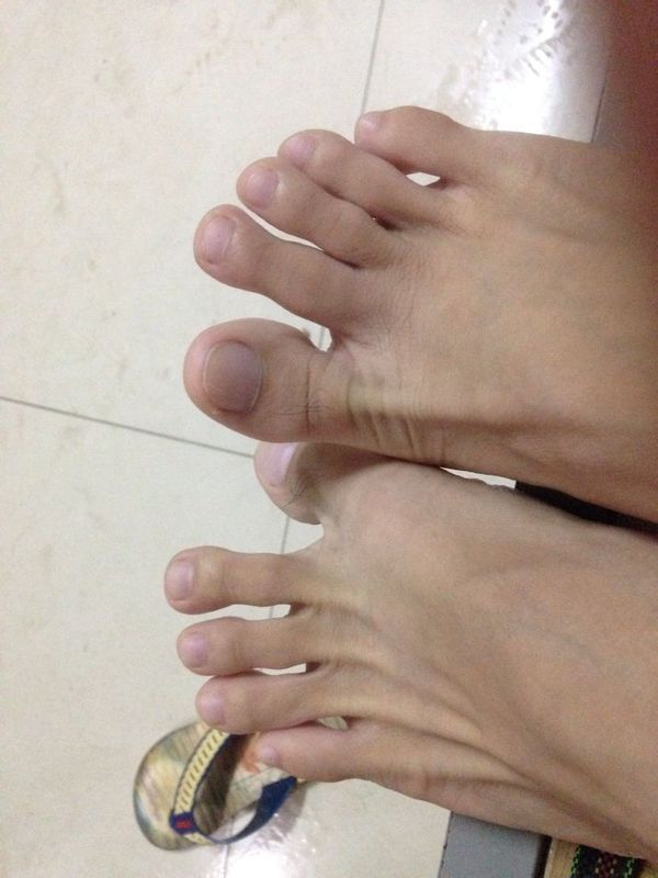 地的时候第二根脚趾扭到了 但是能够弯曲伸直