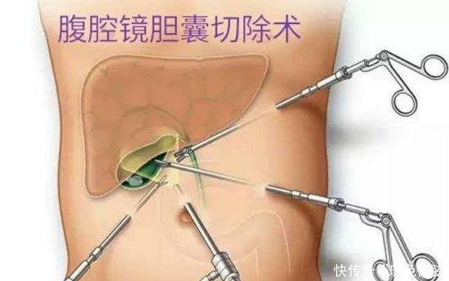 腹腔镜胆囊切除术后,该怎么护理呢?这6点要记