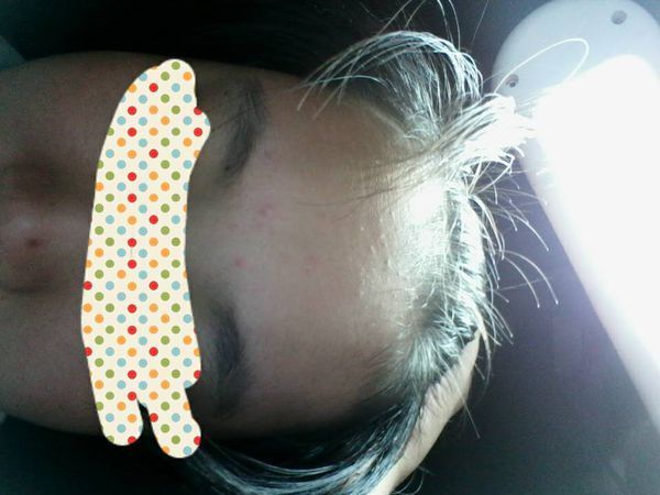 这个是什么痘,额头上的,怎样可以消掉